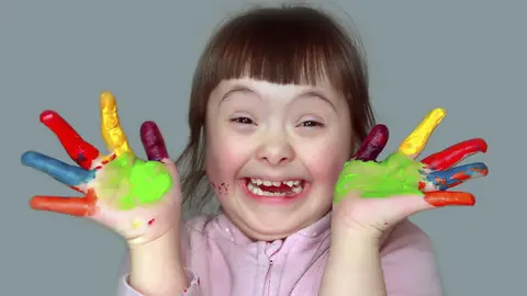 Niña con Síndrome de Down